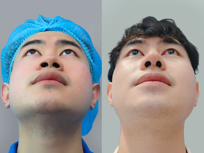 Alar reduction may create the impression of a more defined nose but does not raise the nasal bridge.