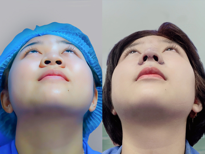 Alar reduction may create a narrower and more balanced nasal base.