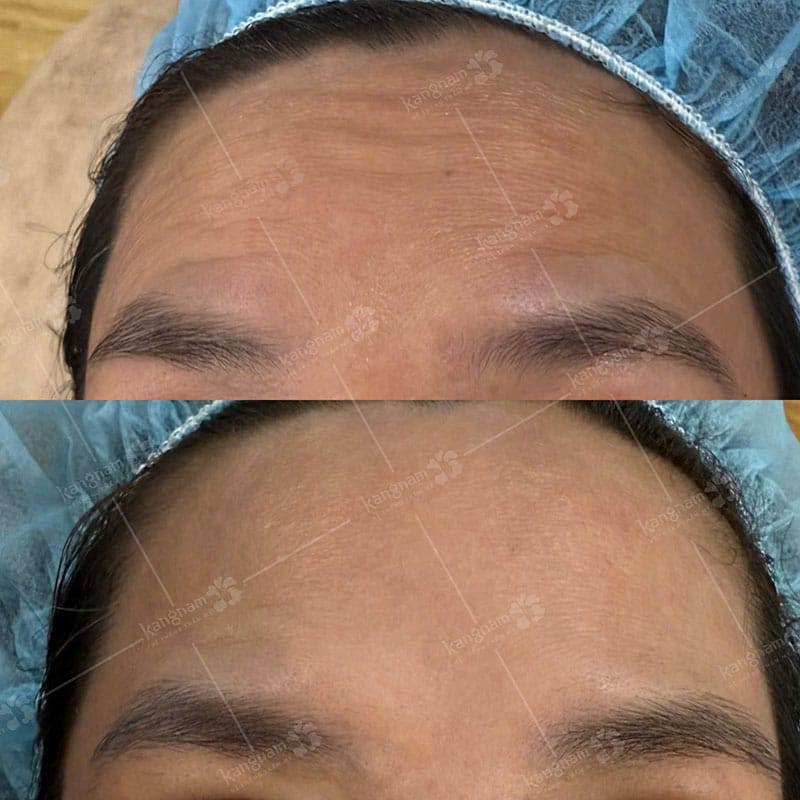 Using an authentic botulinum toxin product may support safer and more predictable results.