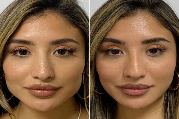Jaw-slimming botox injections do not cause hollow cheeks