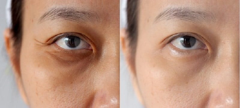 Pregnant women and people with neuromuscular conditions should not receive eye-wrinkle injections without specialist medical advice.