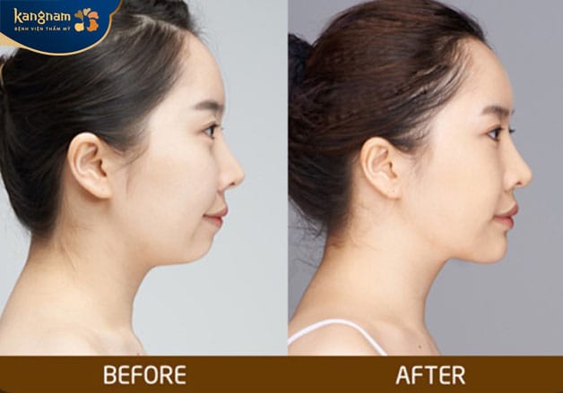 Sau 1- 2 ngày, cằm dần ổn định hơn 
