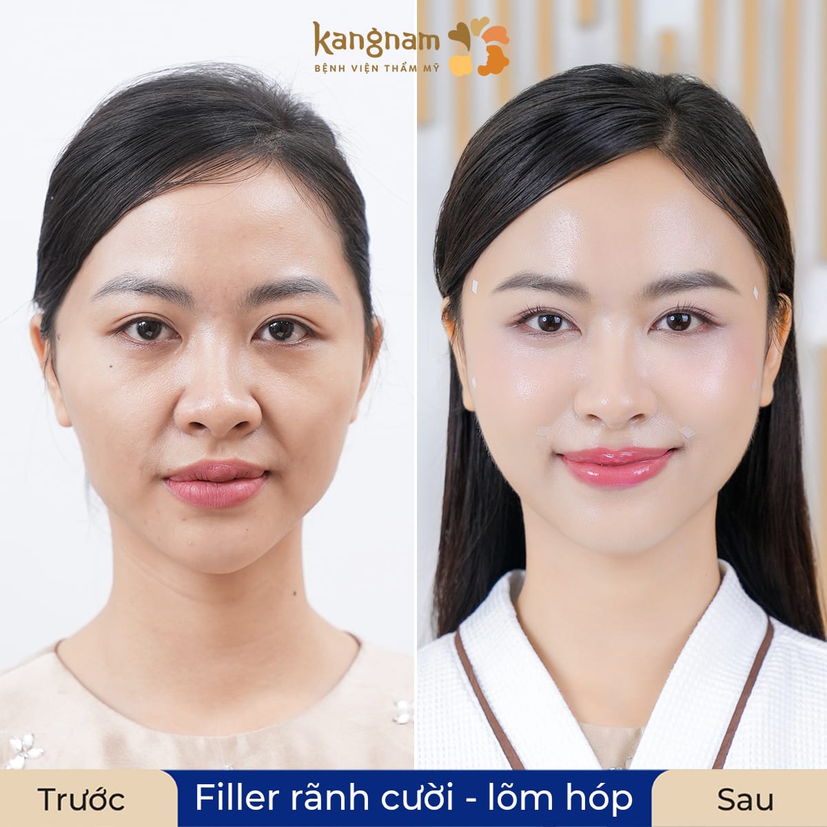 Rãnh cười và khuôn mặt lõm hóp được lấp đầy sau tiêm filler
