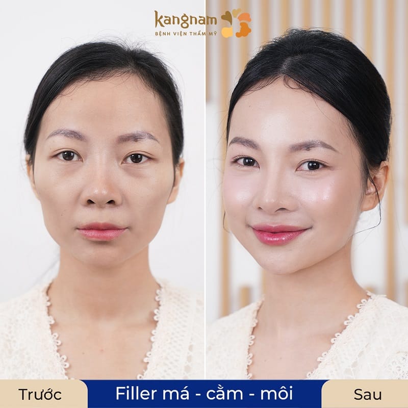 Tiêm filler giúp khách hàng khắc phục được các khuyết điểm
