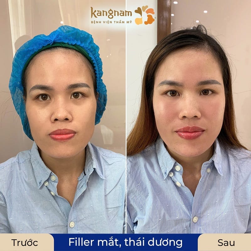 Tùy vào tình trạng của mỗi khách hàng, bác sĩ sẽ tư vấn liều lượng tiêm filler phù hợp