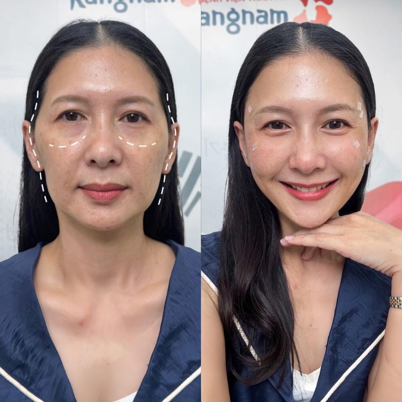 Smile lines and hollow facial areas are filled after filler injection.
