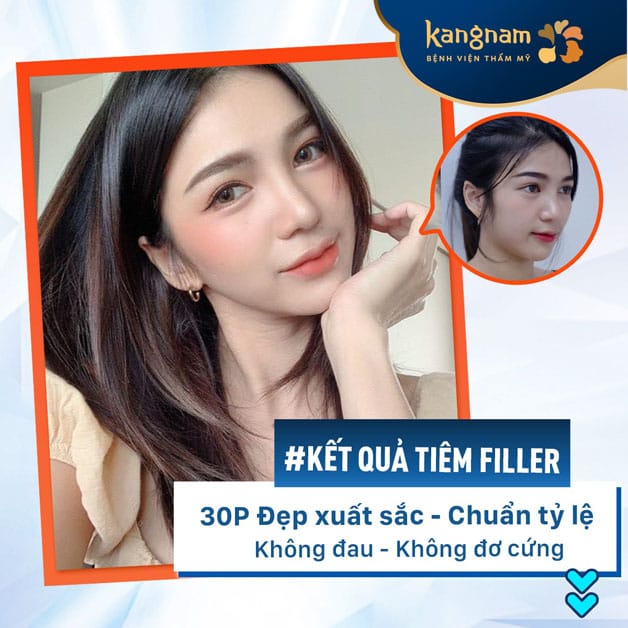 Kết quả tiêm filler đẹp xuất sắc tại Kangnam