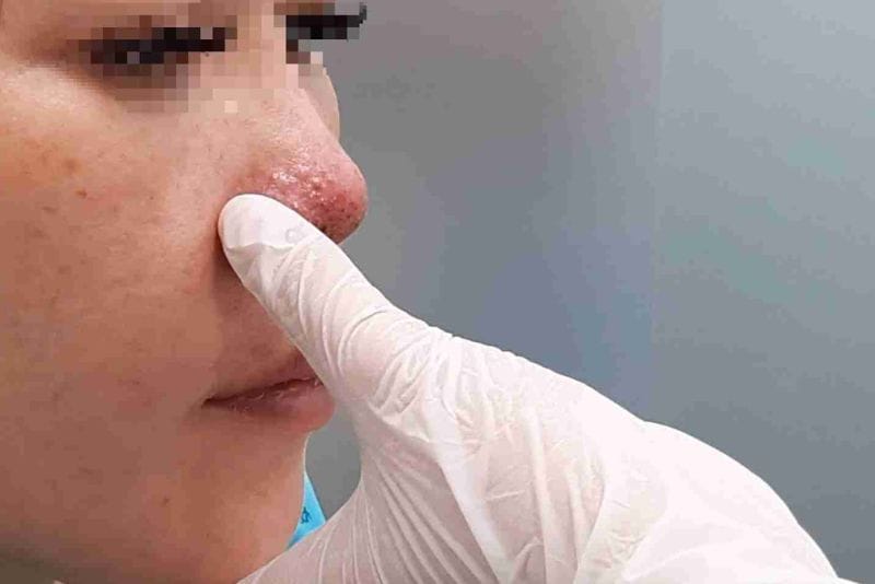 Tiêm filler mũi có thể gây