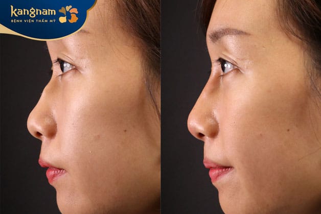 Ưu điểm nổi bật khi tiêm filler mũi là thời gian hồi phục nhanh chóng