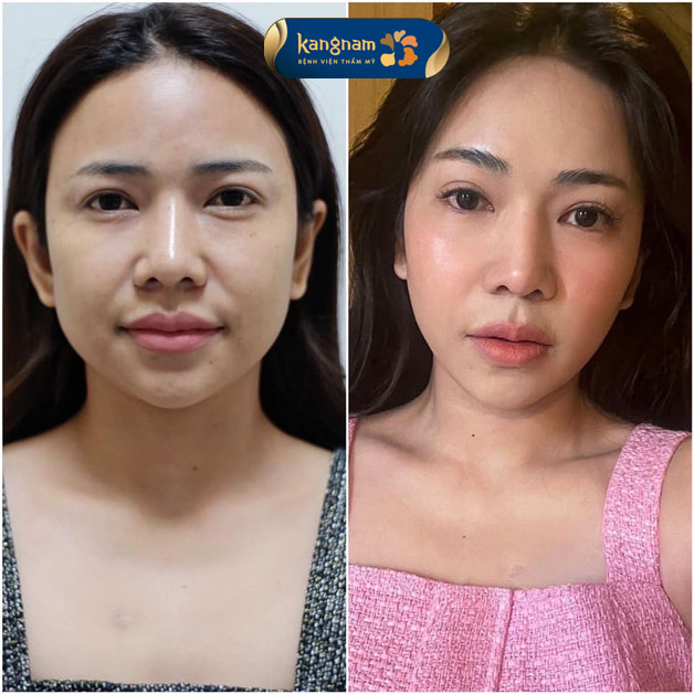 Filler injections help patients correct various aesthetic imperfections.