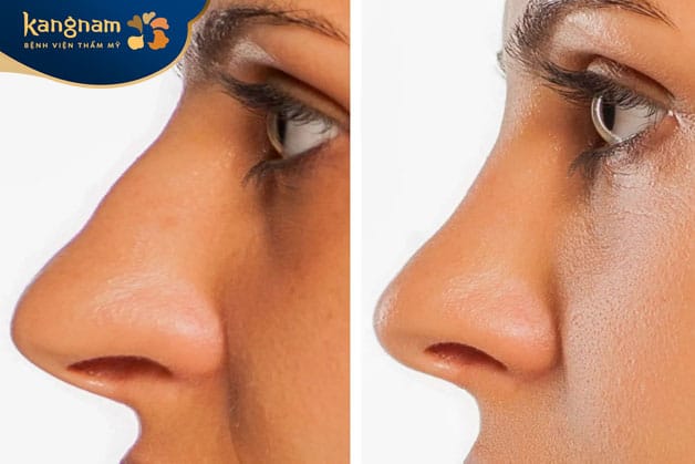 Tiêm filler mũi sẽ trở lại bình thường chỉ sau khoảng 2-3 giờ