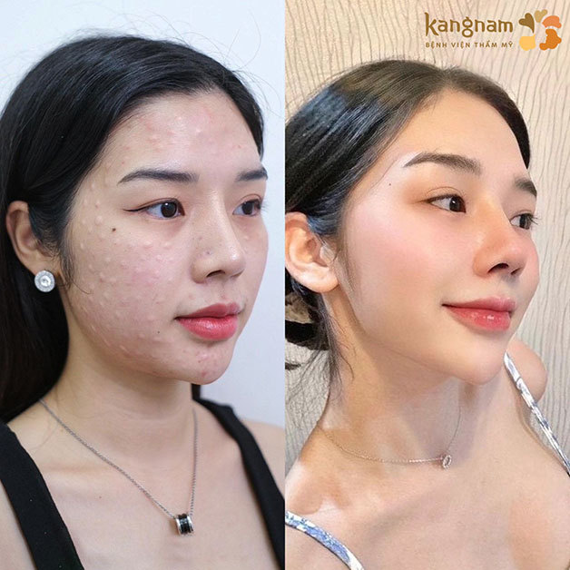 Each skin condition requires a different mesotherapy treatment plan.