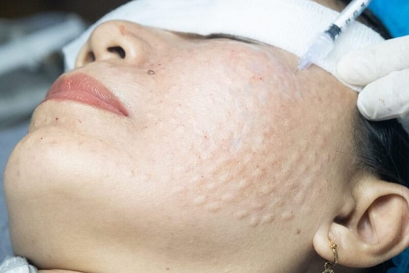 Tay nghề của bác sĩ hay chuyên viên tiêm meso cũng ảnh hưởng đến thời gian có tác dụng