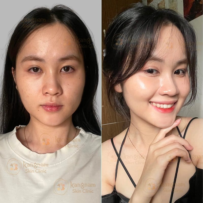 Lựa chọn địa chỉ tiêm meso uy tín, tránh biến chứng xảy ra