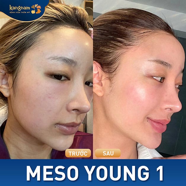 Mesotherapy results last for a limited period and vary between individuals.