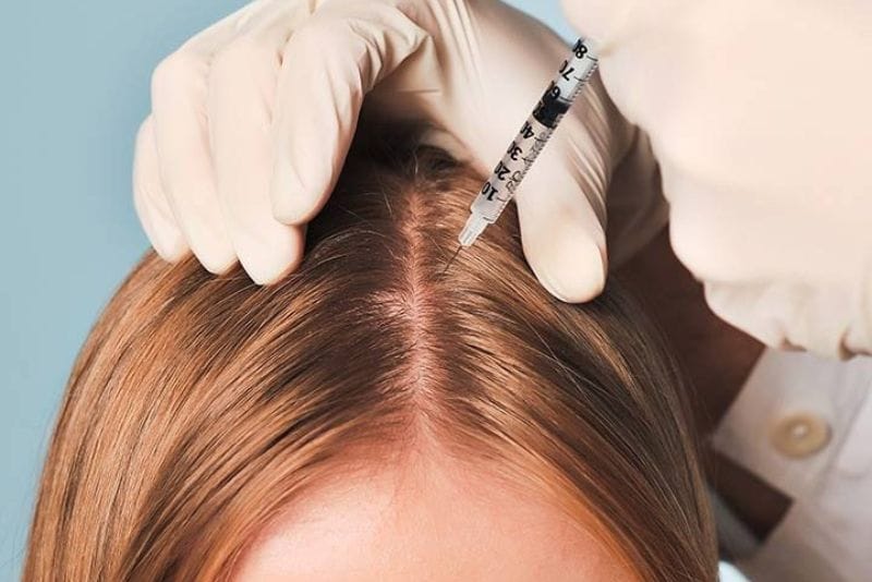 Mesotherapy may support hair-loss treatment and stimulate hair-follicle activity.