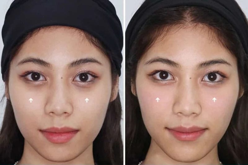 The duration of the result depends on the injectable product, skin condition, and individual lifestyle.