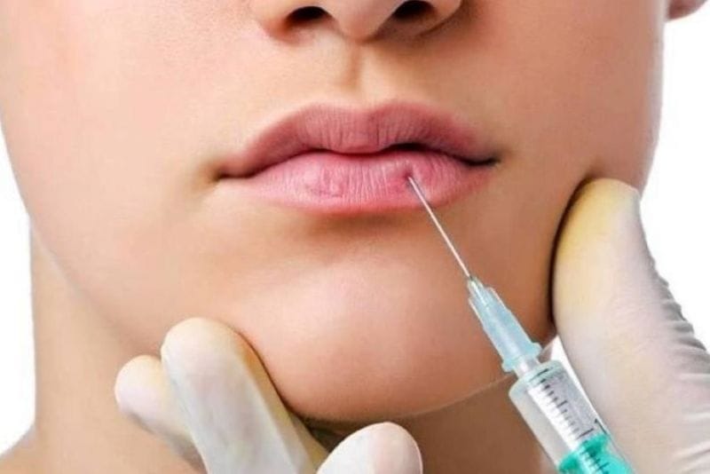 Filler may be injected again once the treated area has fully recovered.