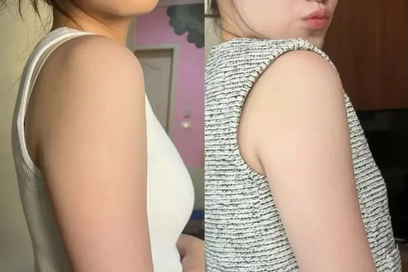 Before and after Botox injections for arm slimming