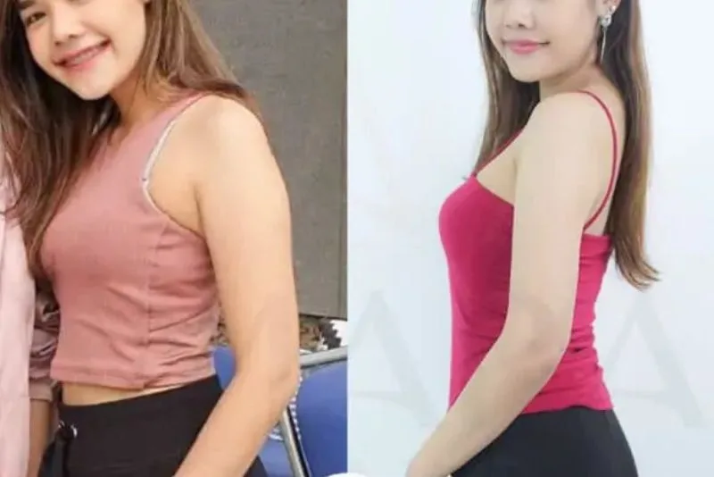 Effective arm-slimming injections for individuals with large arms due to muscle development.