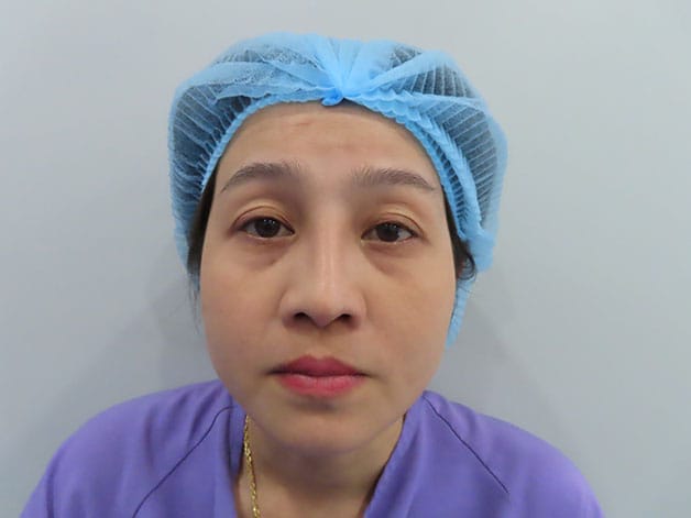Individuals with large eye bags, excess fat, and sagging skin should consider lower blepharoplasty