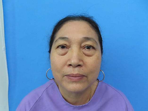 Individuals with large eye bags, excess fat, and sagging skin should consider lower blepharoplasty