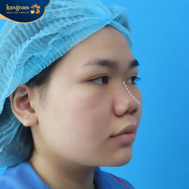 Patients seeking improvement of a low or poorly defined nose may be considered for S-Line rhinoplasty.