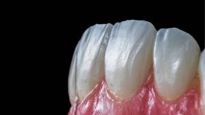 Titan Porcelain Crowns: Affordable and Durable