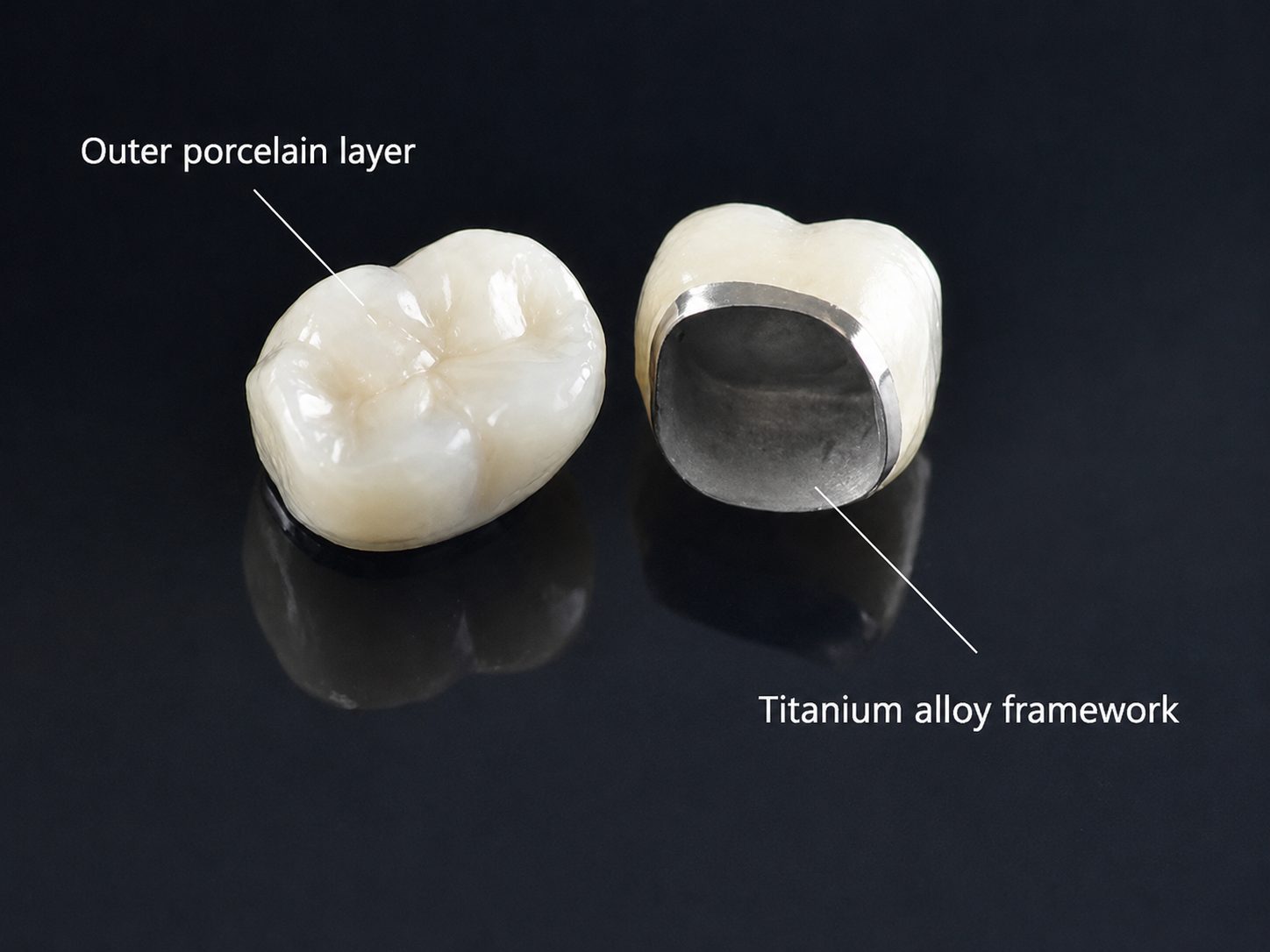 Titan crowns contain titanium, with a framework made from titanium alloy and an outer porcelain coating.