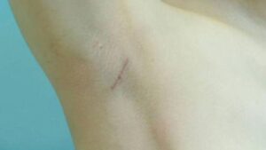 Transaxillary (Armpit) Breast Augmentation: Is It Painful?