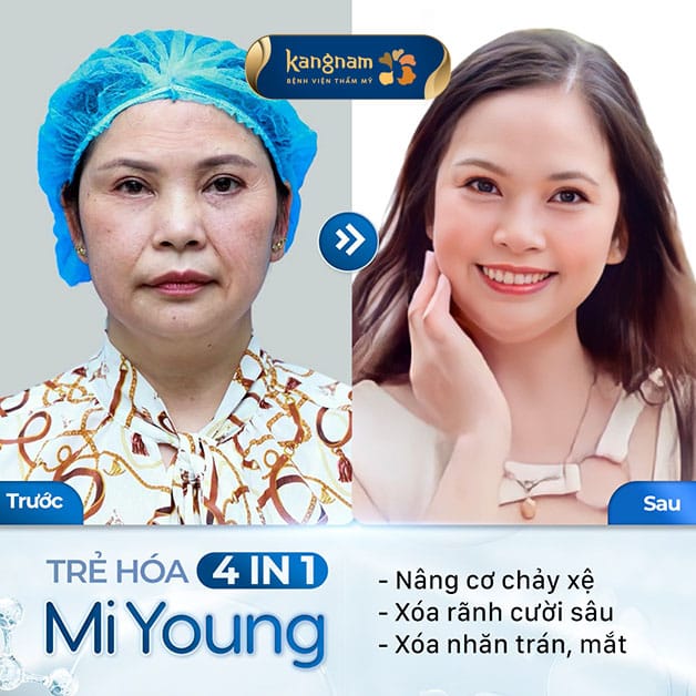 Trẻ hóa da Mi Young giúp bạn trẻ ra 10 tuổi 