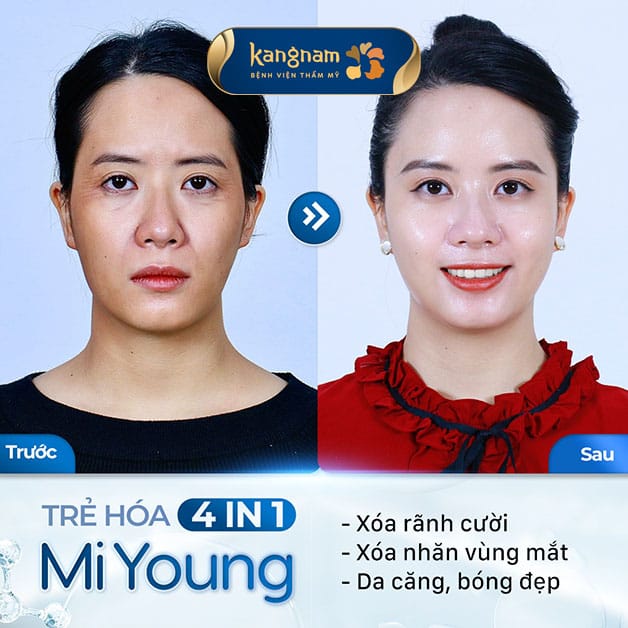 Tại Kangnam ứng dụng công nghệ gây tê tiên tiến nên không hề gây đau đớn 