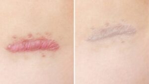 Top 7 Ways to Treat Long-Standing Keloid Scars