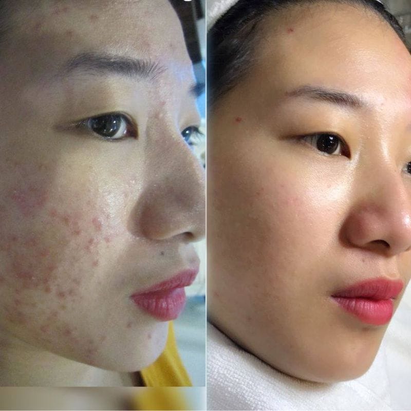 How Much Does Laser Treatment for Dark Scars Cost?