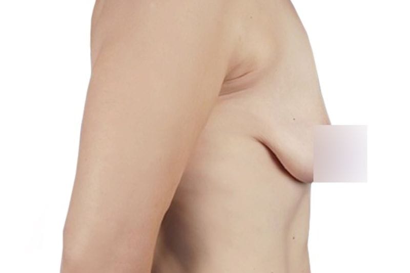 Postpartum breast ptosis condition