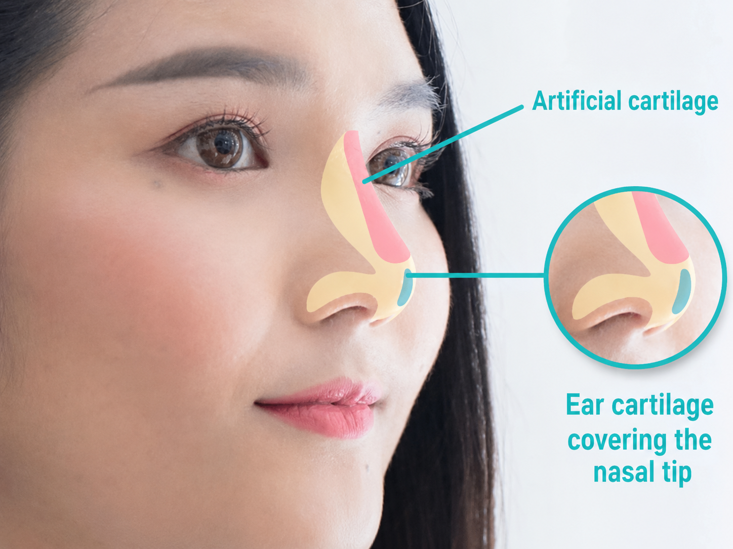 Nasal cartilage and implants are primary materials used to shape the nose and raise the nasal bridge.