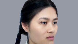 Plow-Shaped (Long) Face Surgery for a Balanced Profile