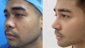 Correcting an Upturned Nose: 3 Effective Methods