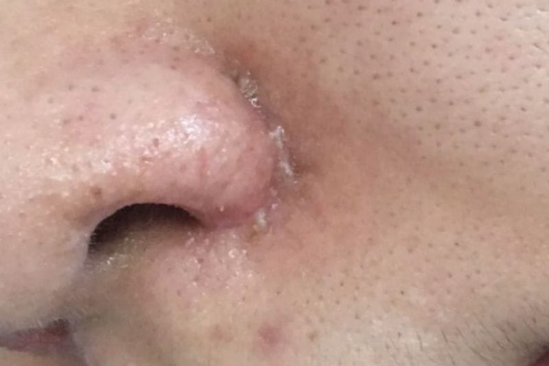 Scabbing along the rhinoplasty suture line is normal.