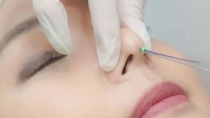 What Is Thread Lift Rhinoplasty? Pros and Cons