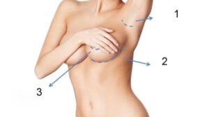 Breast Augmentation Incisions: Which Approach Is Safest?