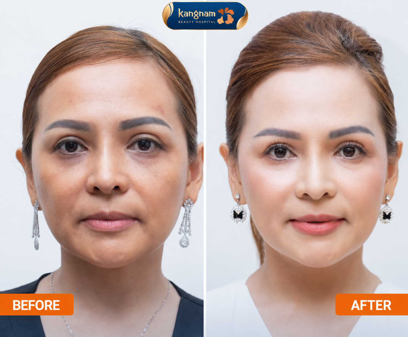 The skin becomes firm, radiant, and brighter, appearing 10 years younger after collagen thread lifting.