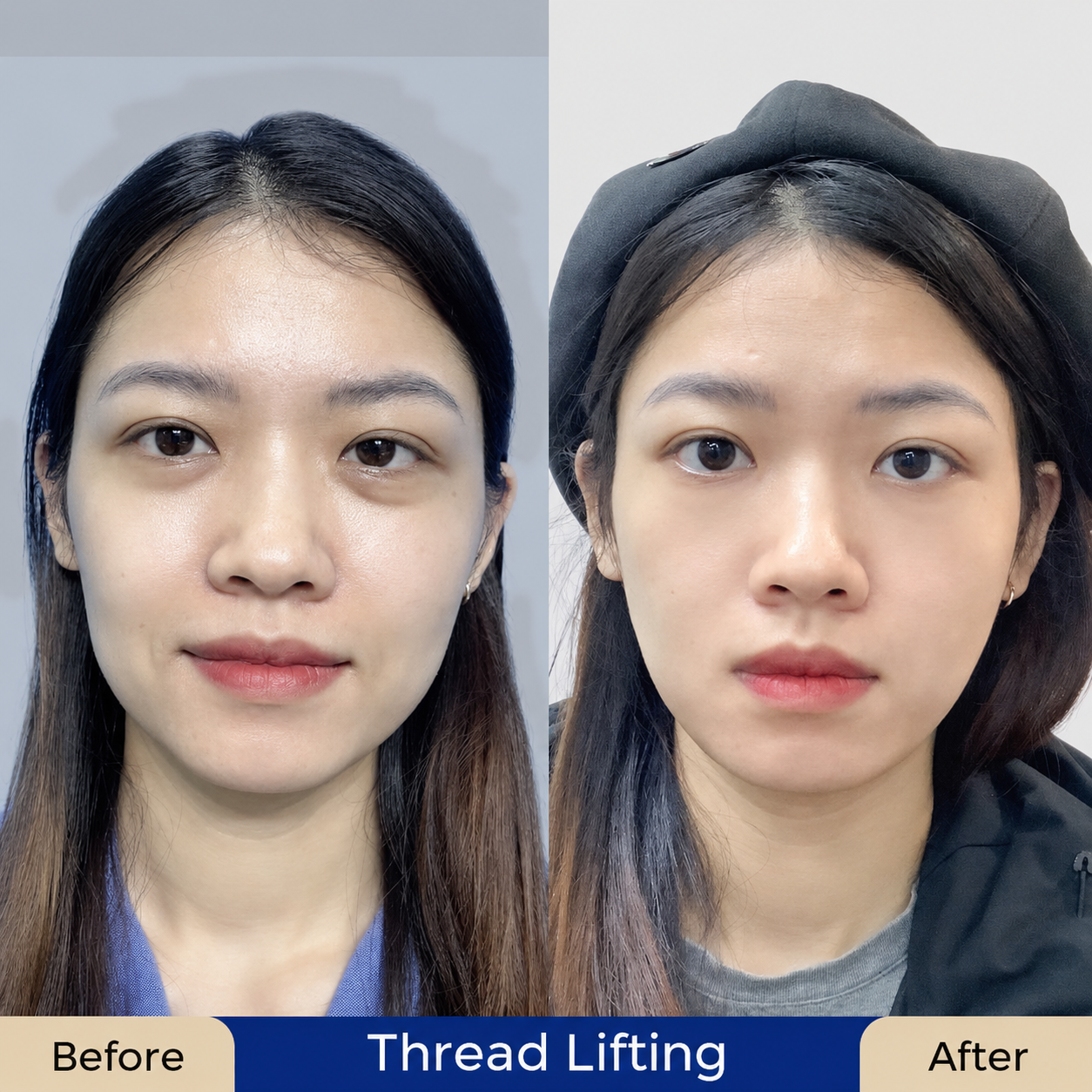 Regaining a youthful appearance with firmer and tighter skin.