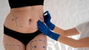 How Many Kilograms Can Liposuction Remove?