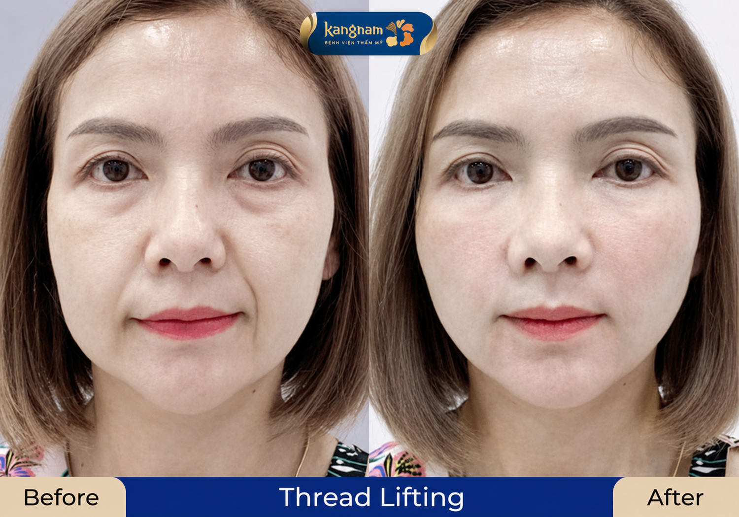 Thread lifting is a safe and non-invasive skin rejuvenation method.
