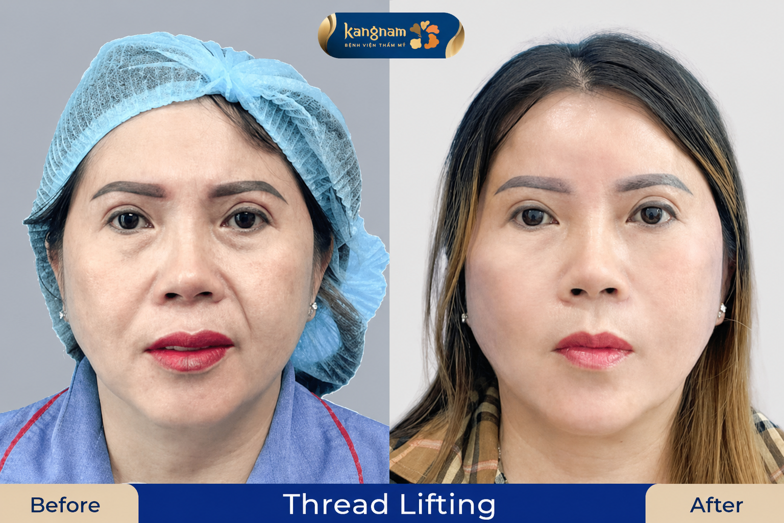 Wrinkles and sagging skin are improved by up to 90%.