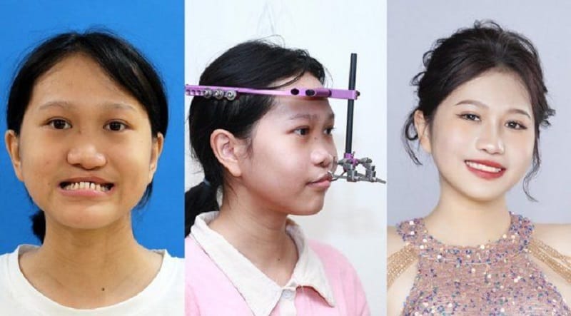 Cleft palate condition resolved without leaving noticeable scars