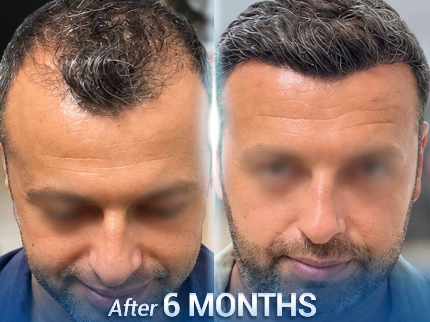 Six months after hair transplantation, the client shows improved coverage across the frontal area and hairline, with the hair gradually becoming fuller and more natural-looking over time.