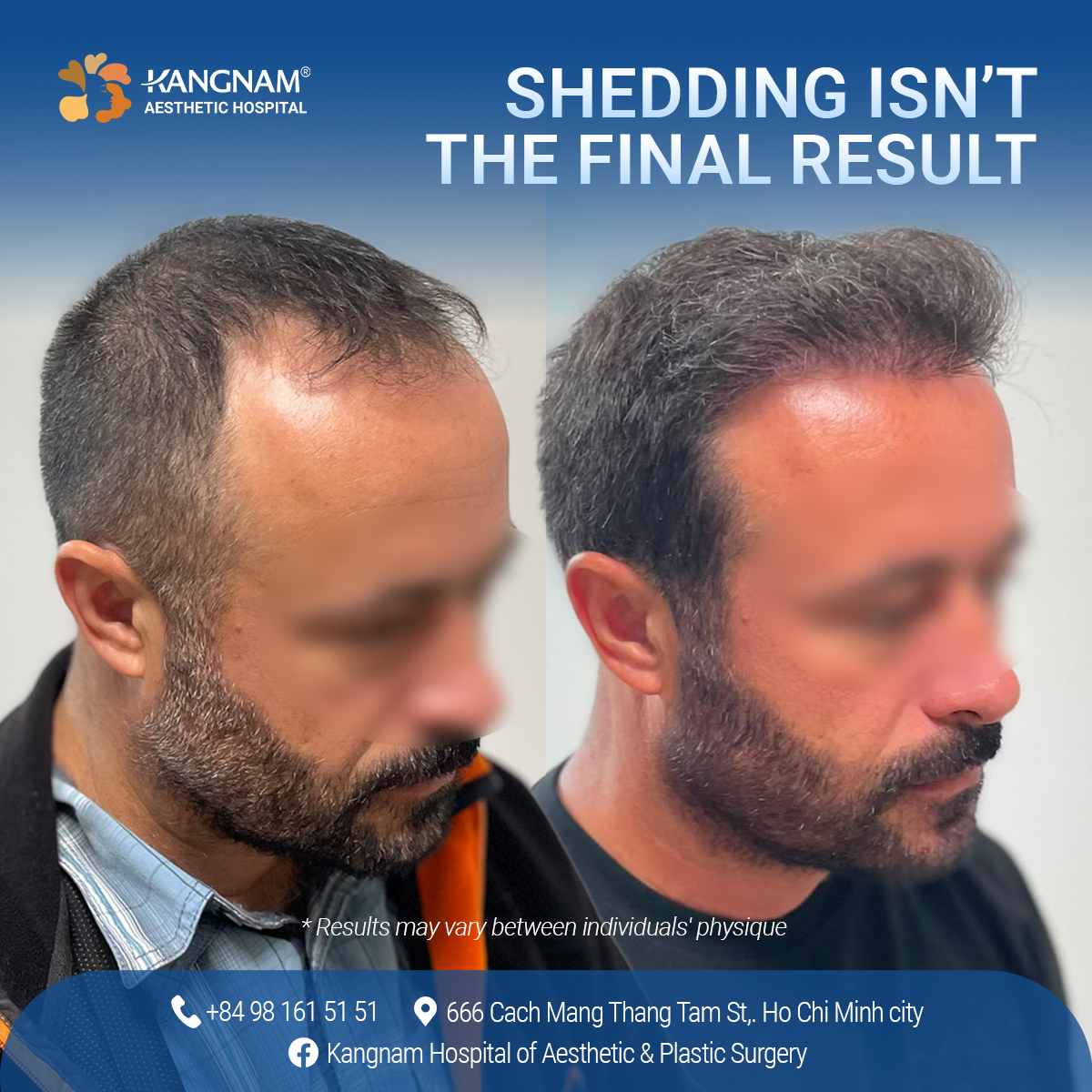 Results after ICEFUE hair transplantation at Kangnam, showing fuller, denser, and natural-looking hair growth.