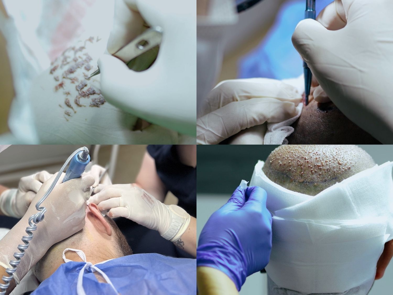 The hair transplant procedure includes harvesting and sorting follicular units, creating recipient sites, and implanting the grafts according to the predetermined direction and density.